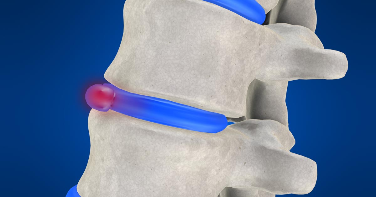 Yakima non-surgical disc herniation treatment