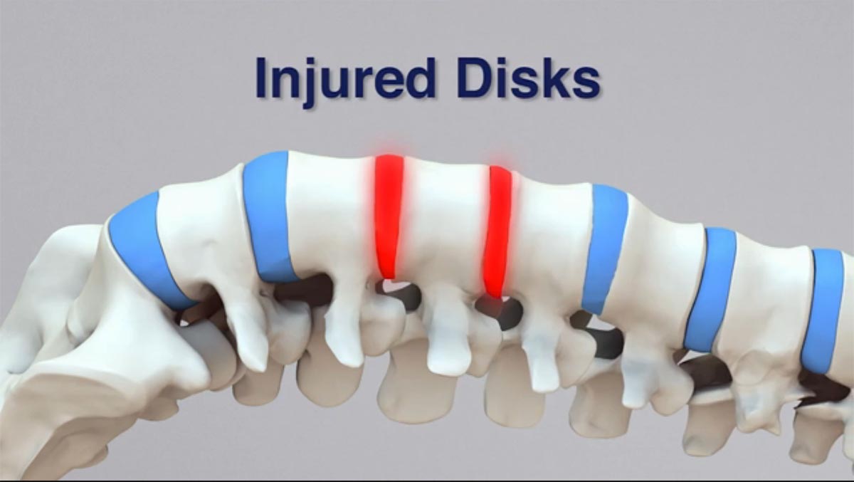 Yakima non-surgical spinal decompression